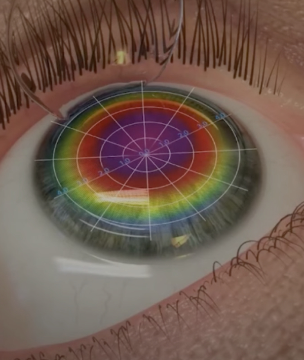 Wavefront I-Design Topo-Guided Lazer